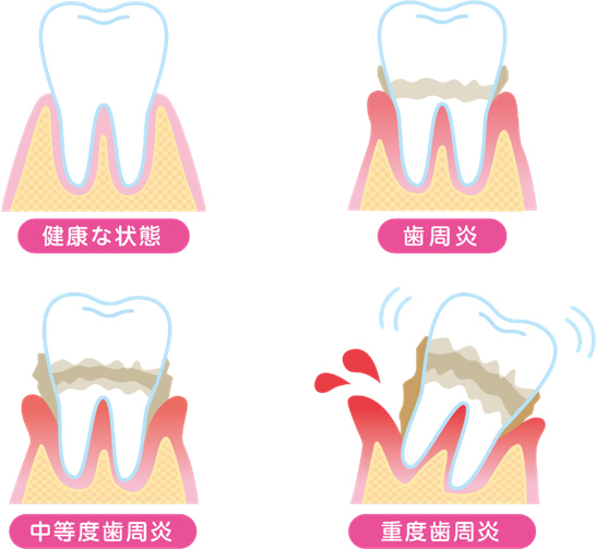 歯周炎、中等度歯周炎、重度歯周炎