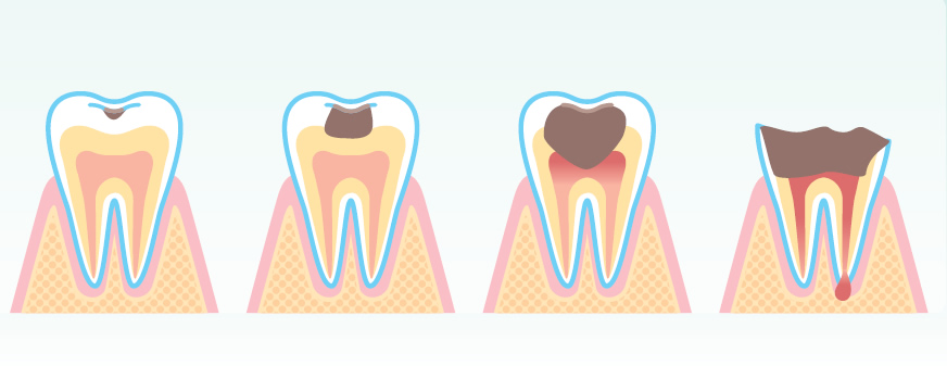 虫歯治療